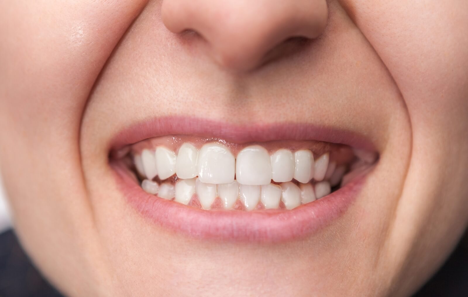 Studio Associato Bianchi implantologia - Prima e Dopo - Novi Ligure - DOPO