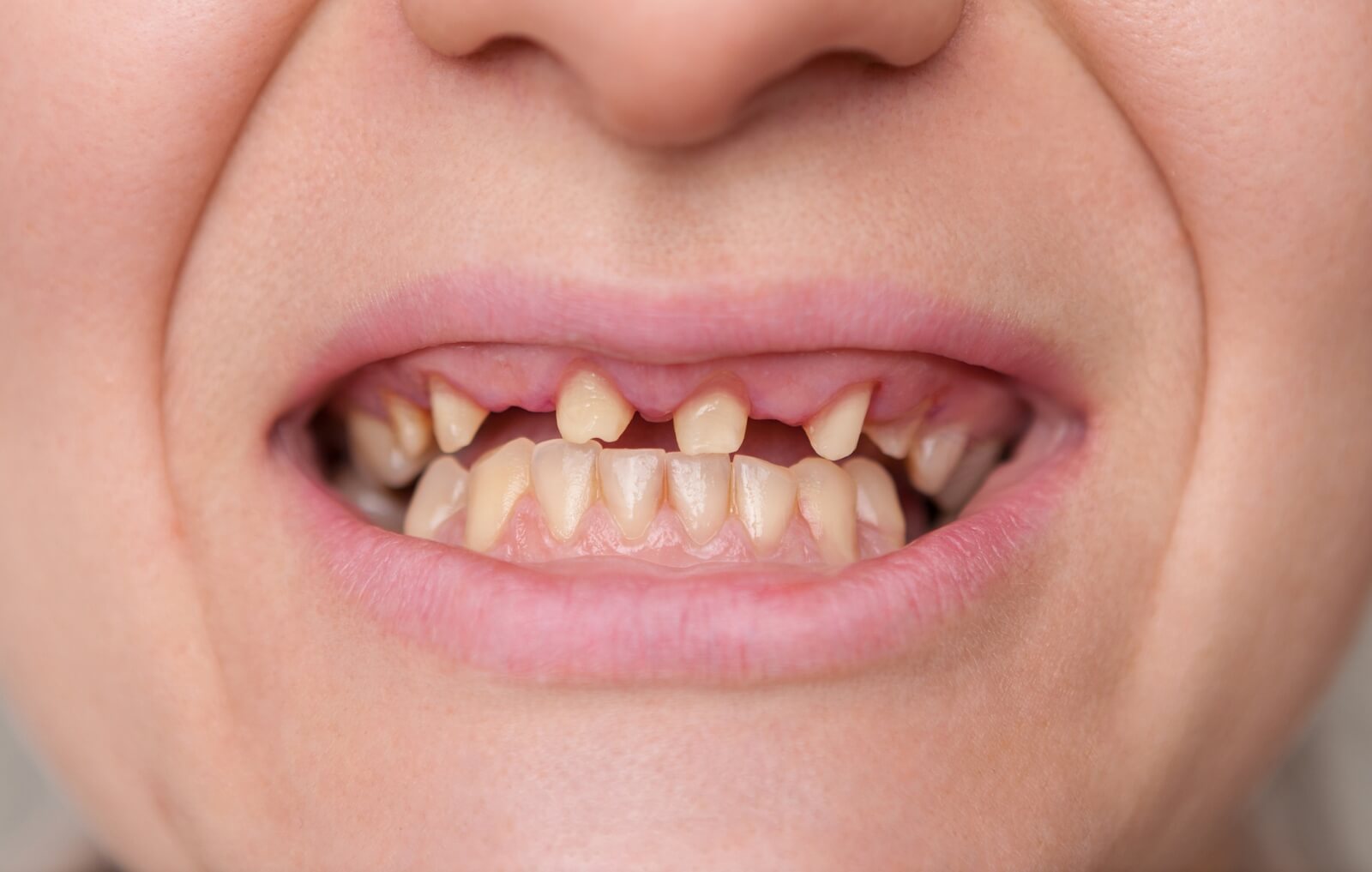 Studio Associato Bianchi implantologia - Prima e Dopo - Novi Ligure - caso 2 - PRIMA