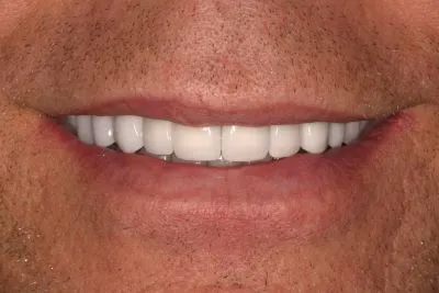 studio dentistico bianchi novi ligure - impianti dentali - caso 1 - DOPO