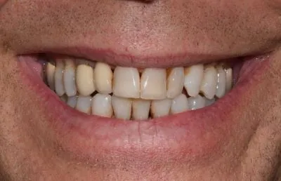 studio dentistico bianchi novi ligure - impianti dentali - caso 1 - prima