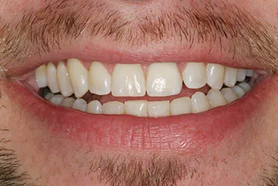 studio dentistico bianchi novi ligure - impianti dentali - caso 2 - DOPO