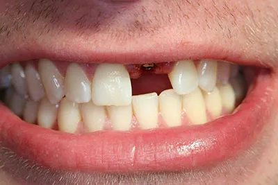 studio dentistico bianchi novi ligure - impianti dentali - caso 2 - PRIMA